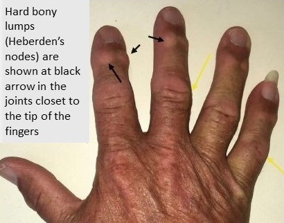 A black hand showing bony lumps (Herbeden's nodes) of osteoarthritis at black arrow