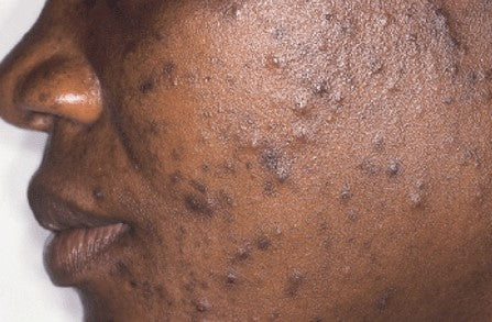 Acne spots on the left face of a black woman