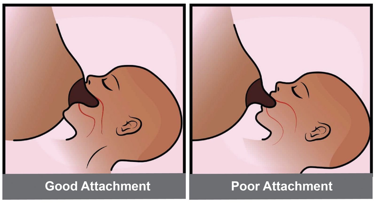 Good and poor baby attachments during breastfeeding