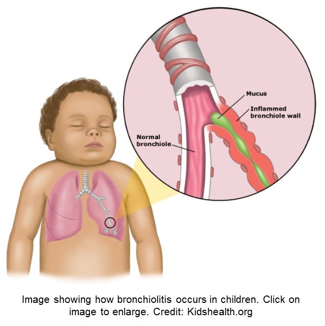 Image of the lower respiratory system with bronchiolitis