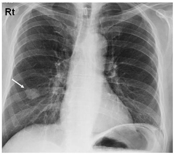 Chest X-ray in a patient with a lung nodule at white arrow