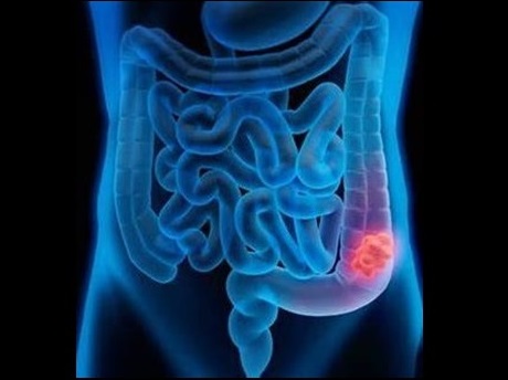 Cartoon image showing a common location for colon cancer