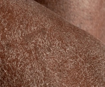 Dry flaky skin  of shoulder region in black person during Harmattan season