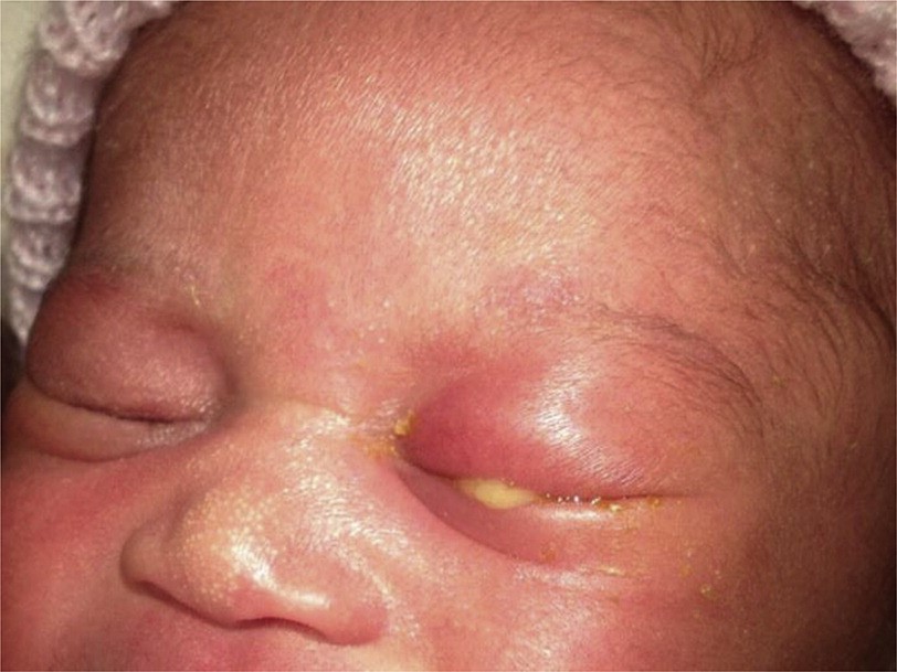 A newborn baby with eye swelling, redness and discharged due to infection