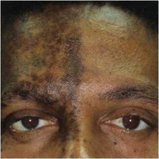 A black individual with right-sided facial shingles of the forehead