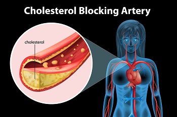 3D cartoon illustration of a woman’s blood circulation and a magnified artery blocked by cholesterol