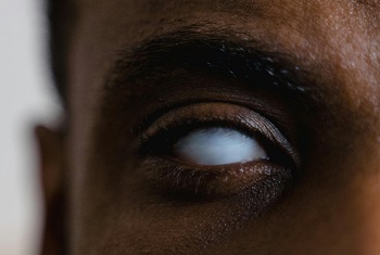 The eye of a black man with total vision loss