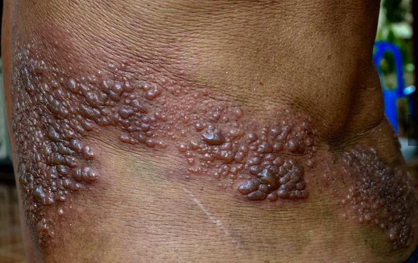 Herpes zoster blisters on the right torso of a black man