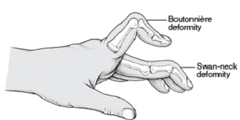 Boutonniere and Swan neck deformities in fingers of hand