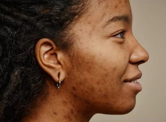 Right side view of the face of a black lady with a skin conditions