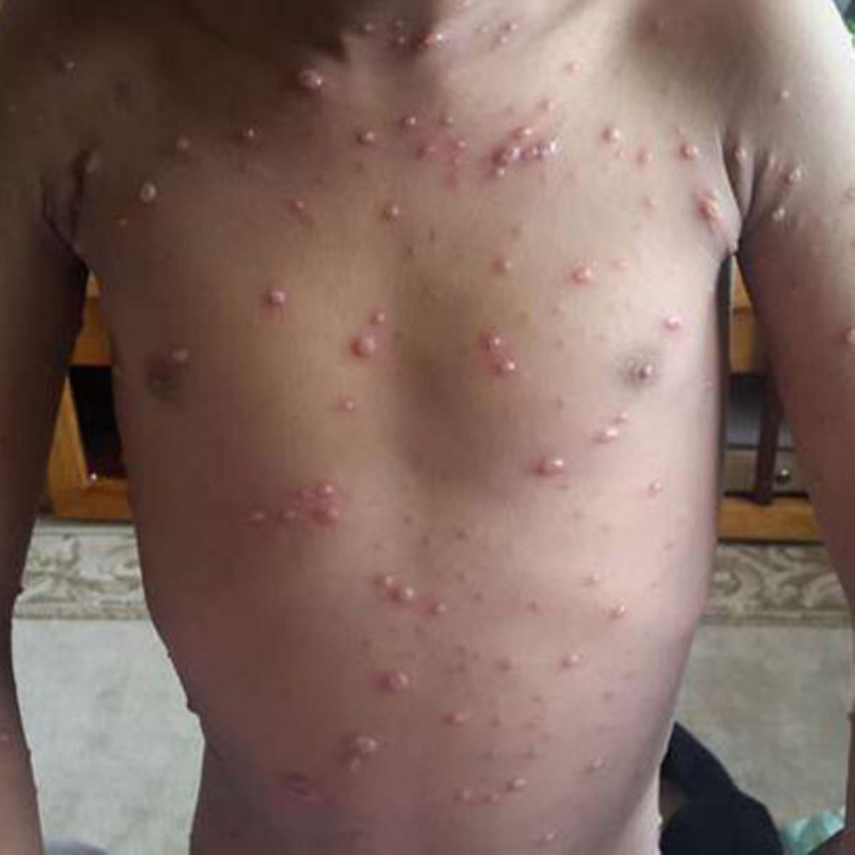 Chickenpox