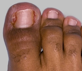 Ingrown toenail of the right big toe