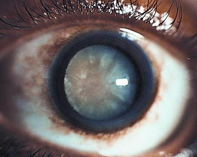 Mature cataract