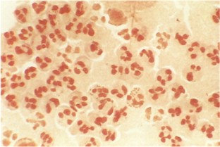 Gram-stain-Neisseria gonorrhoeae