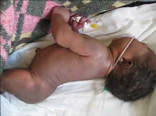 Newborn black baby with tetanus disease