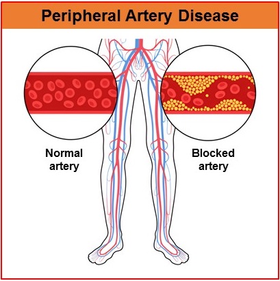 An illustration showing the blood vessels of the lower limbs and magnified views of a normal artery and a blocked artery 