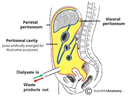 Illustration of peritoneal dialysis set up