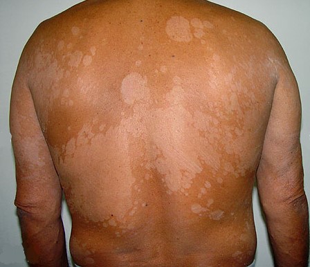An African male with extensive Pityriasis versicolor on the back