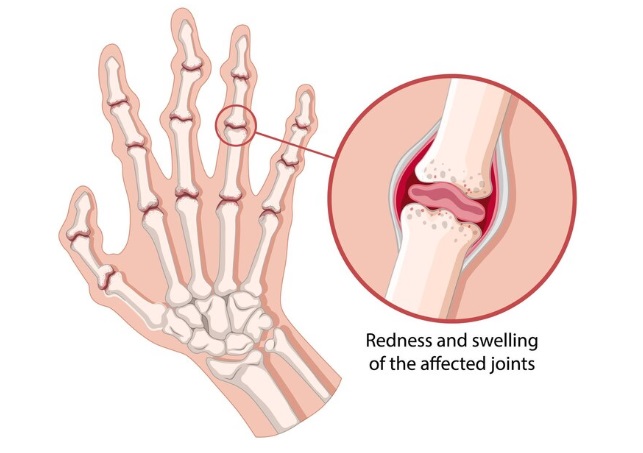 Rheumatoid arthritis of the finger joints