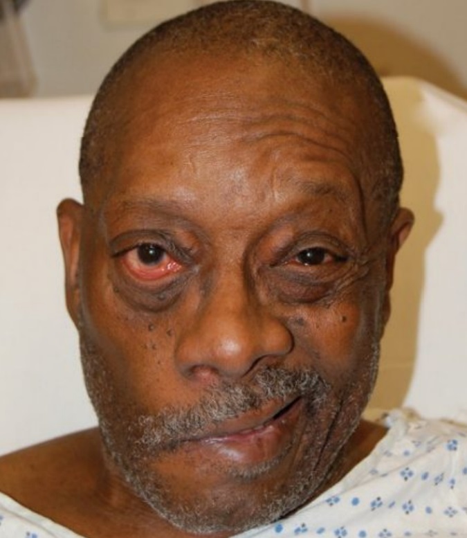 A black man with right-sided Bell's palsy