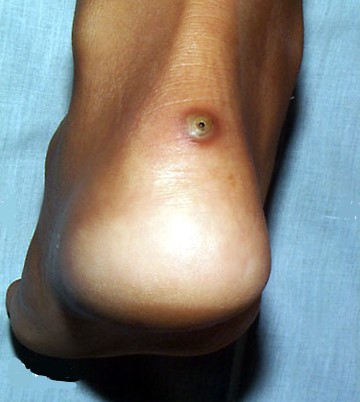 Tungiasis (jigger infestation) of the back of heel.