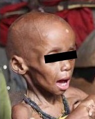 Dehydrated and malnourished African child