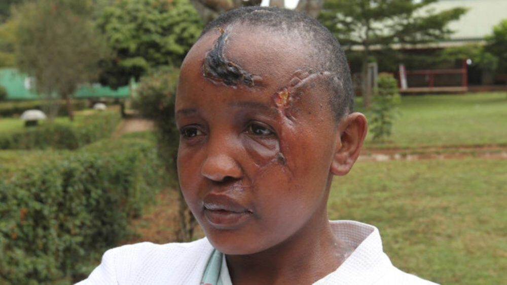 A young African woman with physical injuries from Intimate Partner Violence