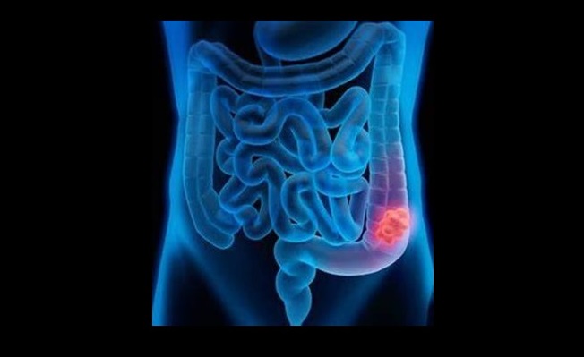 bowel cancer symptoms death Colon cancer: advanced colon cancer symptoms