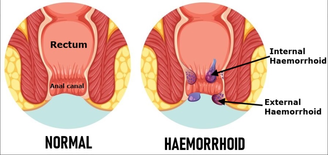Normal anorectal anatomy compared with that in haemorrhoids