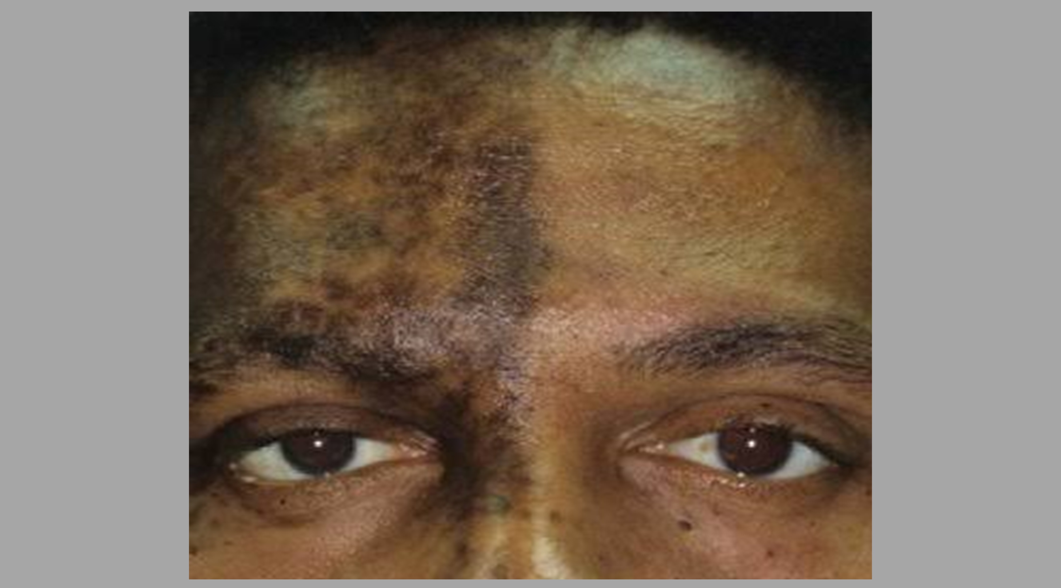 Right-sided facial shingles on the forehead of a black male