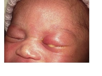 A newborn with swollen eyelids, and thick coloured discharge, likely due to neonatal eye infection