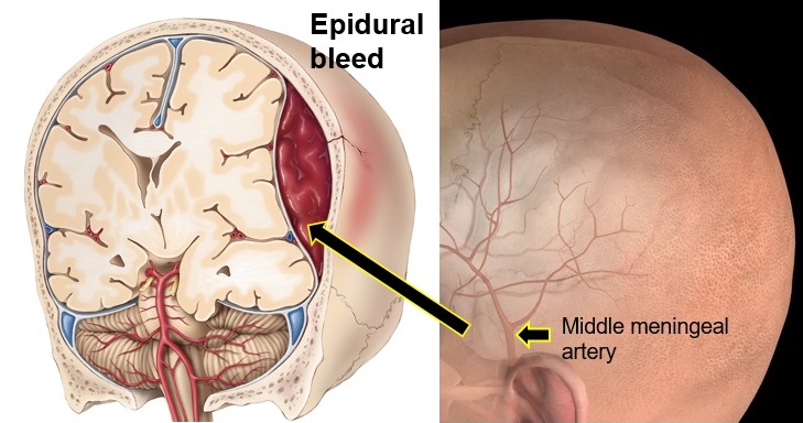 Middle meningeal tear and epidural bleed